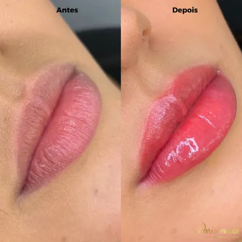 Antes e depois do tratamento estético para lábios realizado no salão de beleza em Moema, São Paulo.