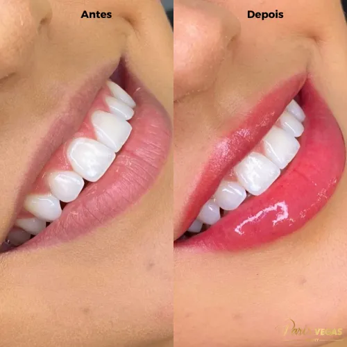 Antes e depois do tratamento de lábios no salão de beleza em Moema, São Paulo.