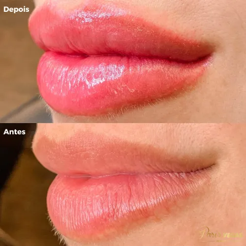 Antes e depois do tratamento estético nos lábios realizado no salão de beleza em Moema, São Paulo.