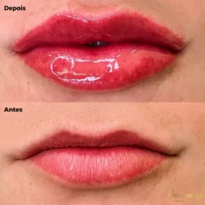 Antes e depois do procedimento de revitalização labial em Moema, São Paulo.