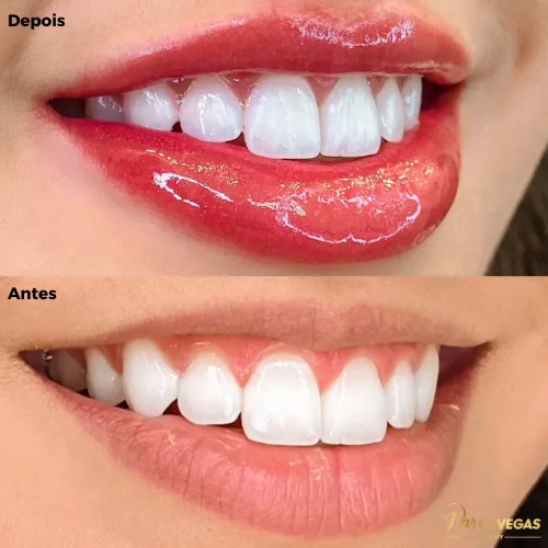 Antes e depois da revitalização labial realizada no salão de beleza em Moema, São Paulo.